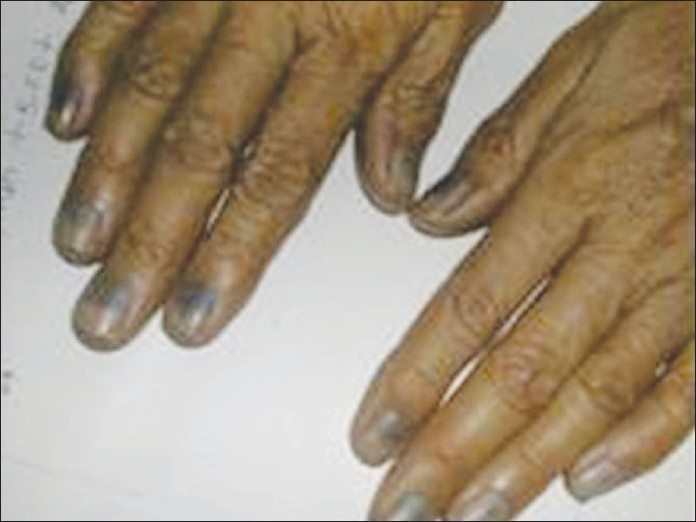 Delayed Nail Findings in Hand-Foot-and-Mouth Disease | Consultant360