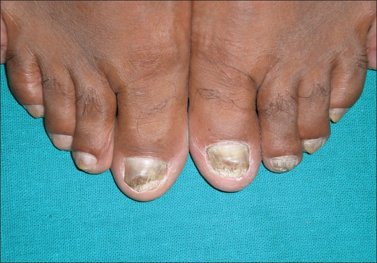 Tinea pedis and Tinea unguium caused by Trichophyton rubrum in an AIDS