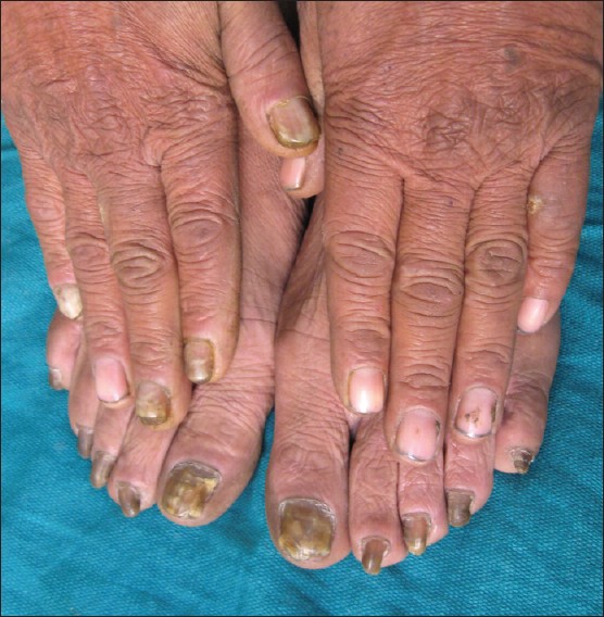 Is manicure and pedicure contraindicated for onychomycosis (tinea unguium)?