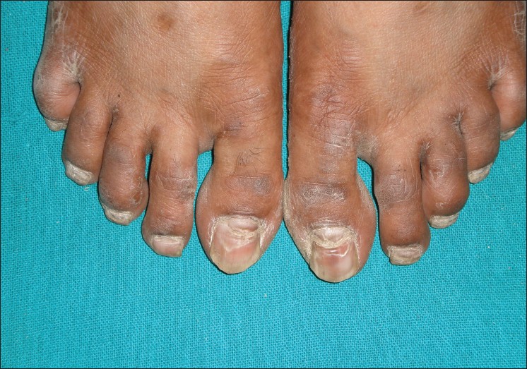 Onychomycosis: Diagnosis and management - Indian Journal of Dermatology,  Venereology and Leprology