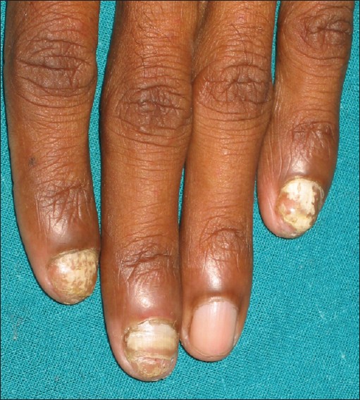 Is manicure and pedicure contraindicated for onychomycosis (tinea unguium)?