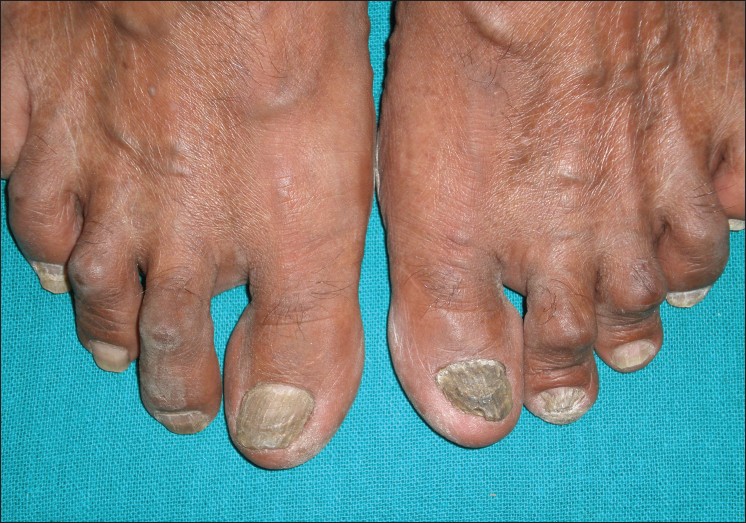 Distal Lateral Subungual Onychomycosis Next Steps In Dermatology ...