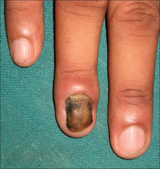 Is manicure and pedicure contraindicated for onychomycosis (tinea unguium)?