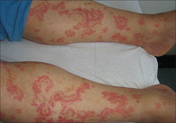 erythema gyratum repens