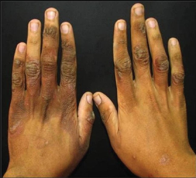 Zinc Responsive Acrodermatitis In Nephrotic Syndrome A Rare