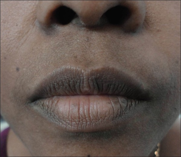 Vitiligo On The Lips Pictures