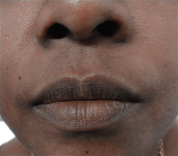 Vitiligo lip pigmentations/ permanent lipstick with 90% success results by  Skin Machine Tattoo studio | Bhopal India | whatsapp us for more info :...  | By Skin Machine Tattoo StudioFacebook