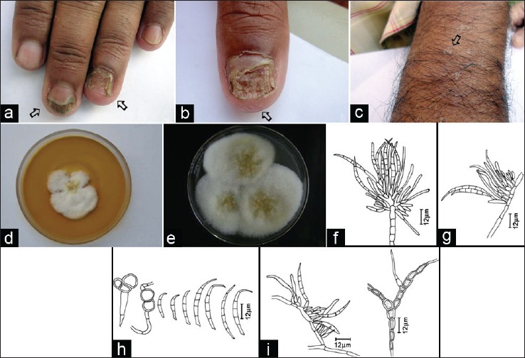 Practical Pearls in Cutaneous Fungal Infections and Onychomycosis - Part 1  - Next Steps in Dermatology