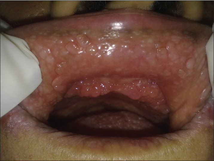 Papilloma in the tongue - Papilloma growth on tongue