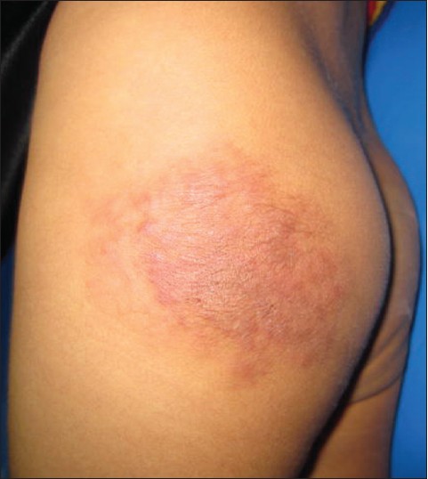 Erythematous Plaque on the Groin and Buttocks