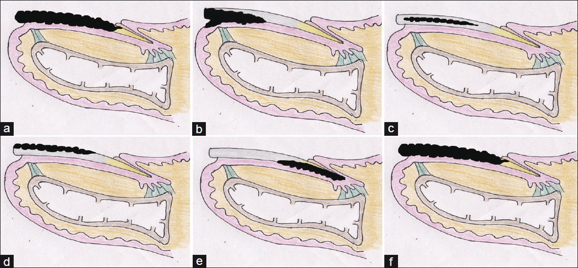 Practical Pearls in Cutaneous Fungal Infections and Onychomycosis - Part 1  - Next Steps in Dermatology