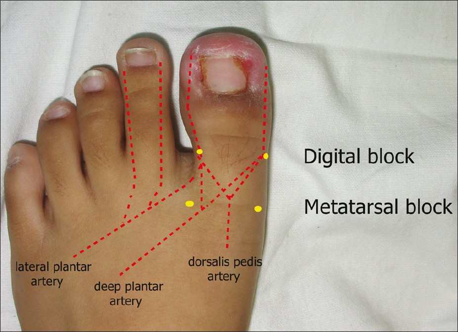 Ingrown toenails - Indian Journal of Dermatology, Venereology and Leprology