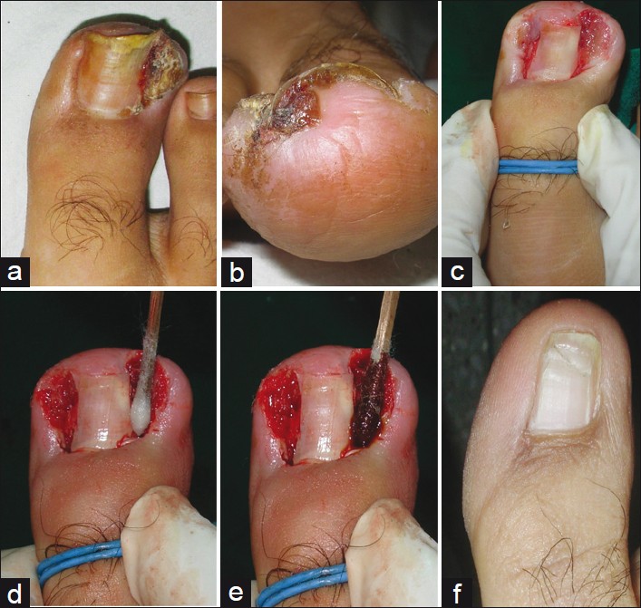 Ingrown toenails - Indian Journal of Dermatology, Venereology and Leprology