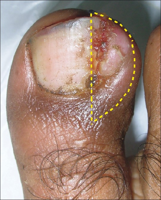 a) patient with ingrown toenail; b) V-shaped excision in the angle of... |  Download Scientific Diagram