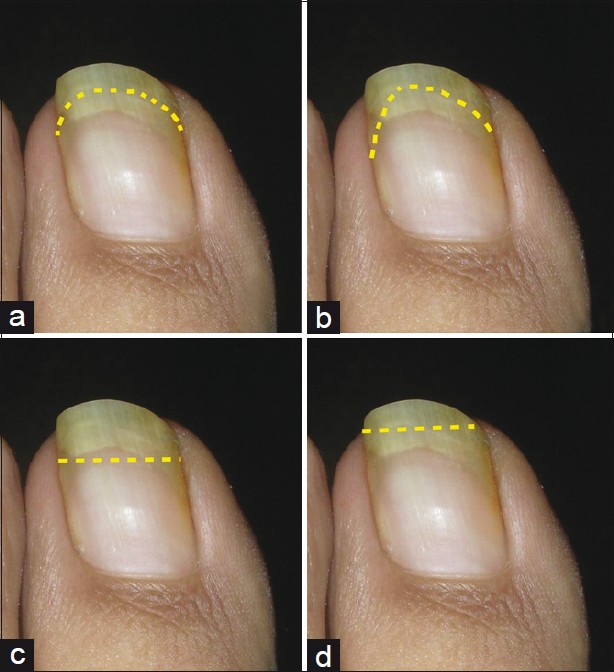 Congenital malalignment of the big toe nail - Wagner - 2012 - JDDG: Journal  der Deutschen Dermatologischen Gesellschaft - Wiley Online Library