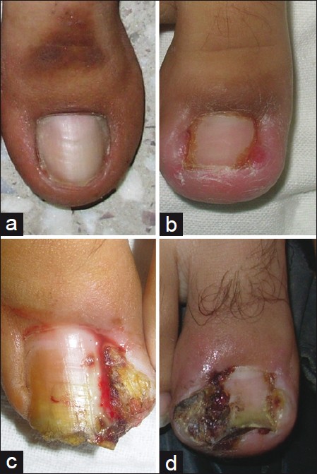 Ingrown toenails - Indian Journal of Dermatology, Venereology and Leprology