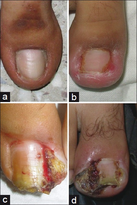 The Three Stages of Ingrown Toenails