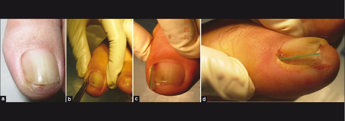 What's the Latest Cost for Carpal Tunnel Surgery?