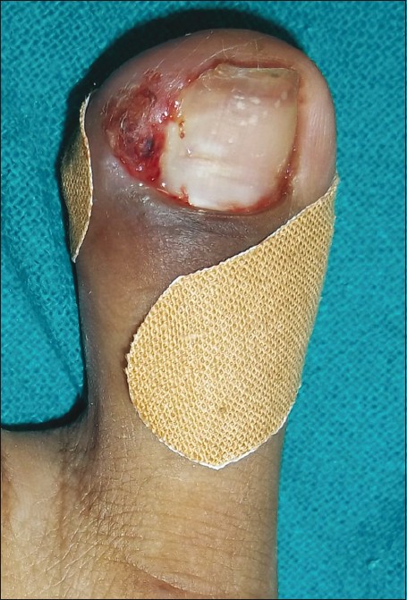 Ingrown Nails (Onychocryptosis, Ingrown toenails) - Dermatology Advisor