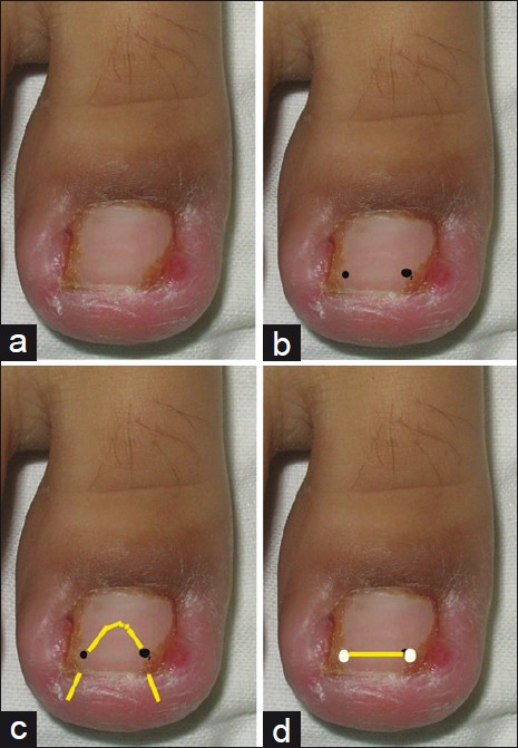 Ingrown Nails: Background, Pathophysiology, Etiology