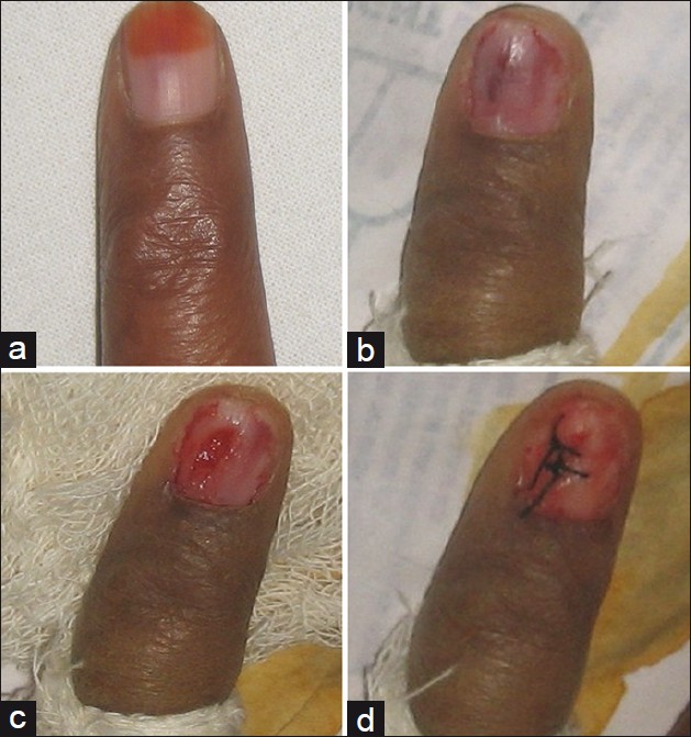 Congenital malalignment of the great toenail: Conservative and definitive  treatment - Domínguez‐Cherit - 2021 - Pediatric Dermatology - Wiley Online  Library