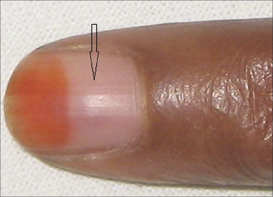 Indian Journal Of Dermatology Venereology And Leprology Nail Avulsion Indications And Methods Surgical Nail Avulsion