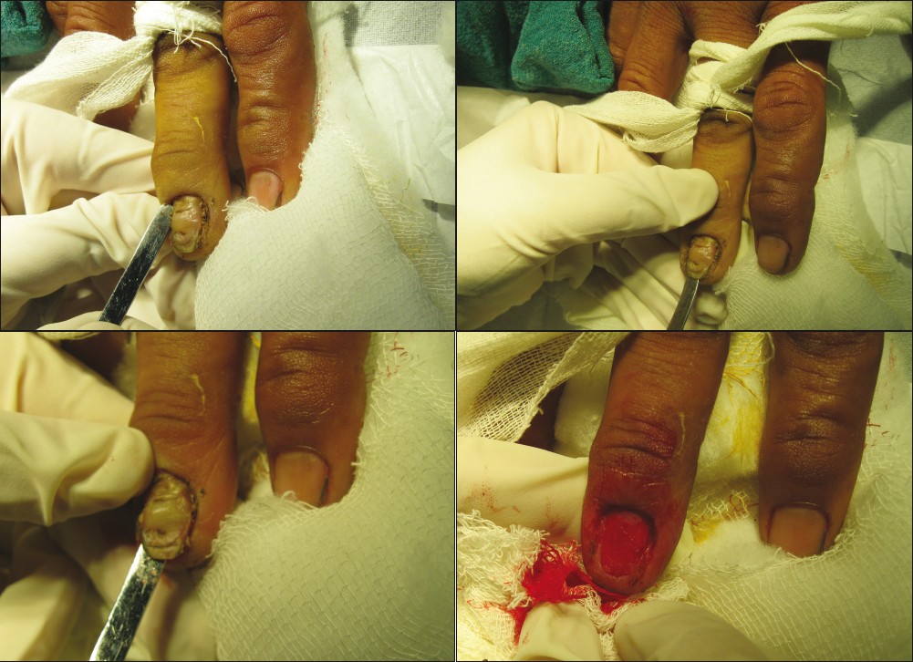 Nail avulsion: Indications and methods (surgical nail avulsion) - Indian  Journal of Dermatology, Venereology and Leprology