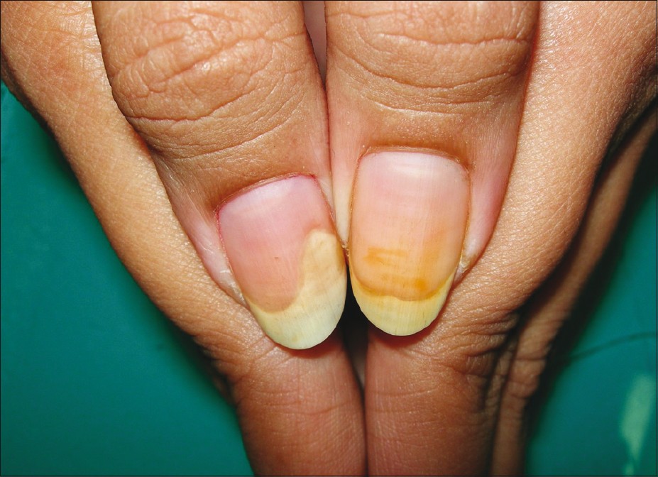 Manicures trigger rash, allergic reaction: 'Lifelong consequences'