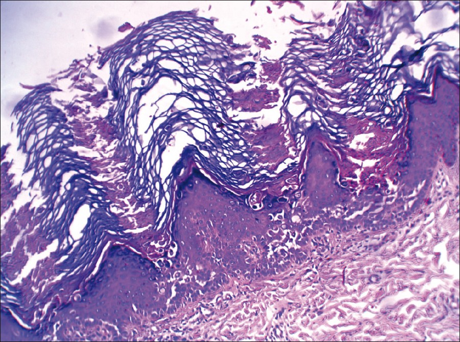 Acantholytic Dyskeratotic Epidermal Naevus Indian Journal Of Dermatology Venereology And