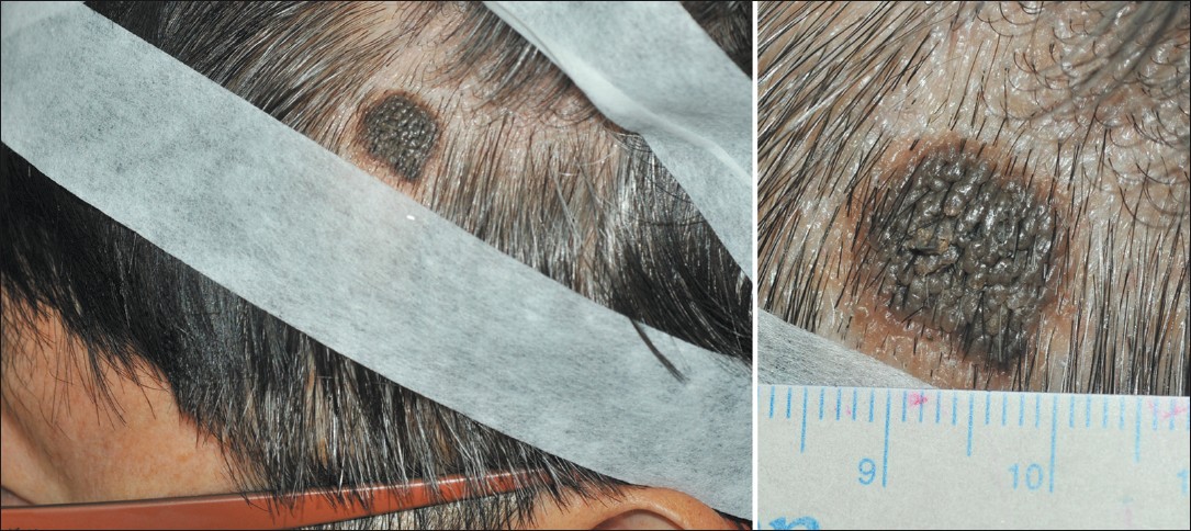 seborrheic keratosis scalp