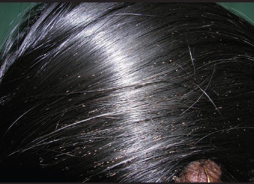 lice nits in black hair