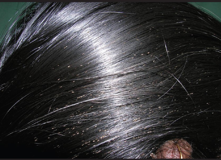 head lice vs dandruff pictures