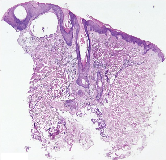 verrucous hemangioma