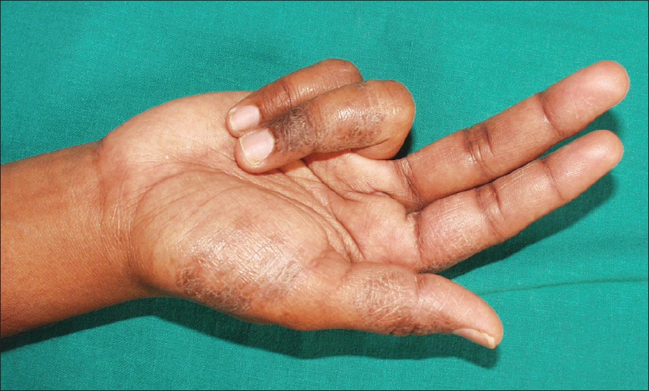 Hyperkeratotic plaques and fi ssures on the palms