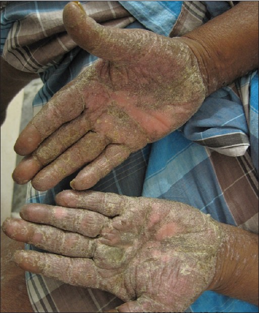 Hand eczema: An update - Indian Journal of Dermatology, Venereology and  Leprology