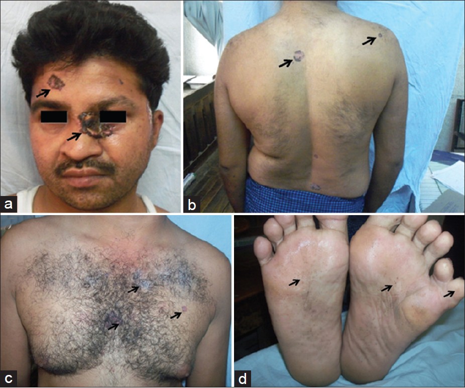 The patient exhibits further signs of basal cell nevus syndrome