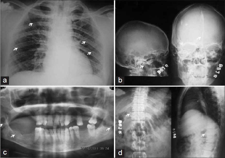 nevoid basal cell carcinoma syndrome