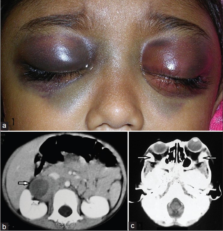 Raccoon Eyes In A Case Of Metastatic Neuroblastoma Indian Journal Of