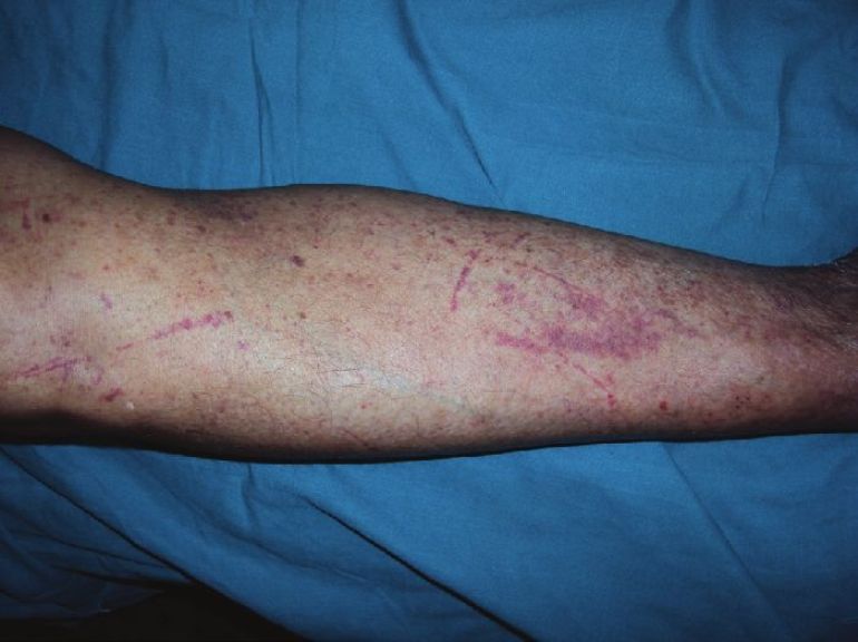 henoch schonlein purpura arthritis