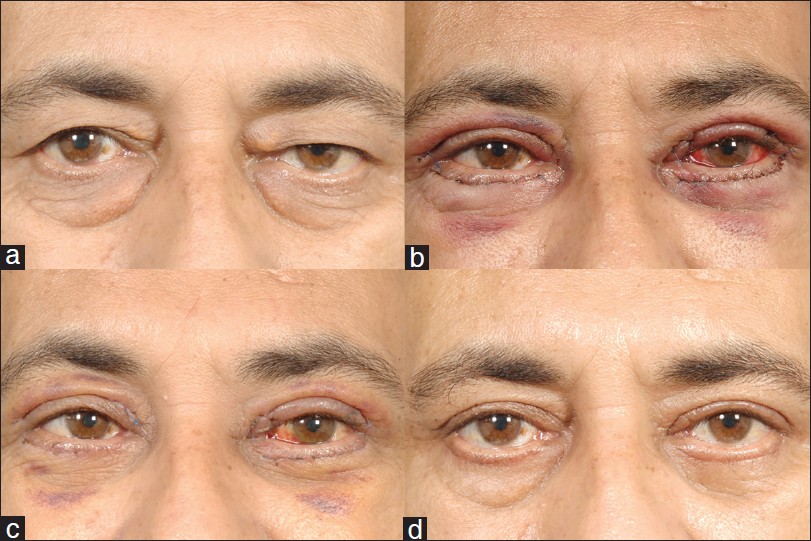 Blepharoplasty and periorbital surgical rejuvenation - Indian Journal of  Dermatology, Venereology and Leprology