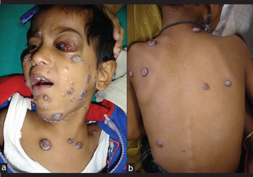 blastomycosis oral lesions