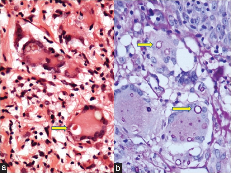 blastomycosis histology