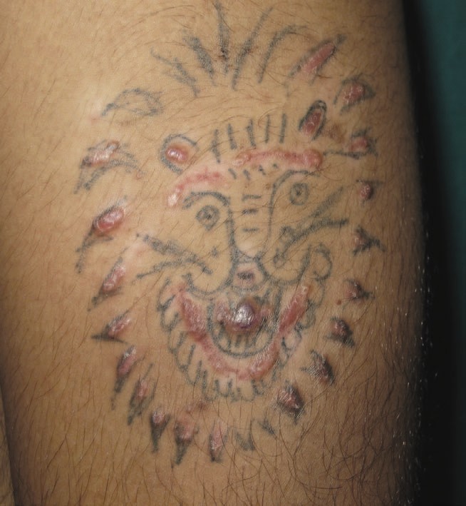 PDF) Scleroderma-like Reaction Restricted to the Red Parts of a Tattoo