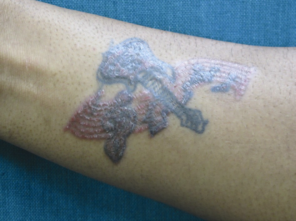 Eruptive Milia Within a Tattoo - Next Steps in Dermatology