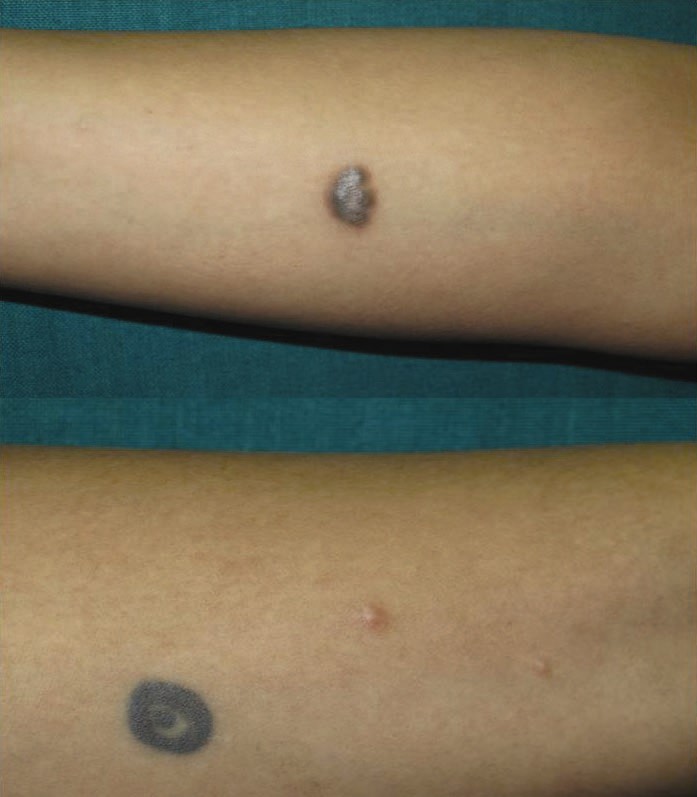 Granulomatous reaction to red tattoo pigment treated with allopurinol -  Godinho - 2015 - Journal of Cosmetic Dermatology - Wiley Online Library