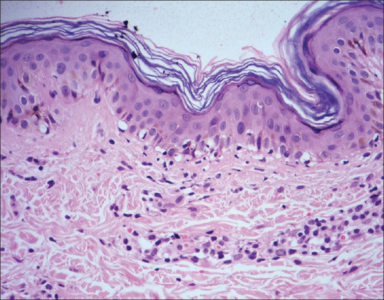 allergic contact dermatitis histology