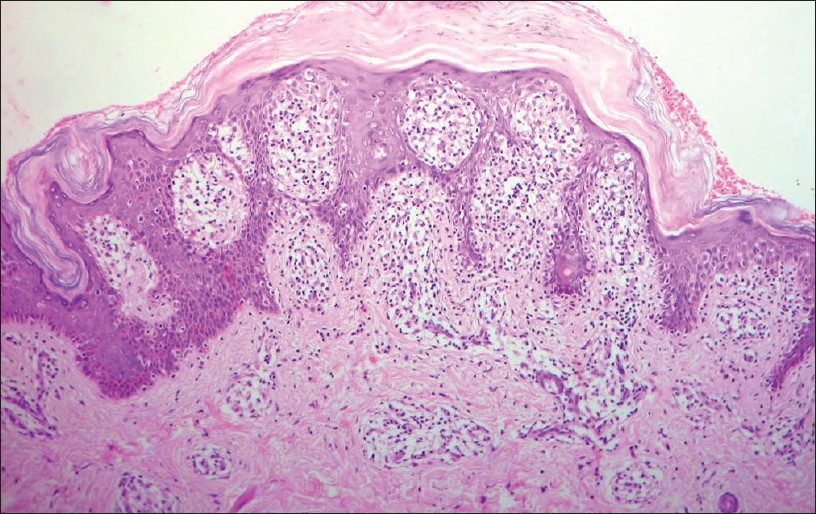 Interface dermatitis - Indian Journal of Dermatology, Venereology