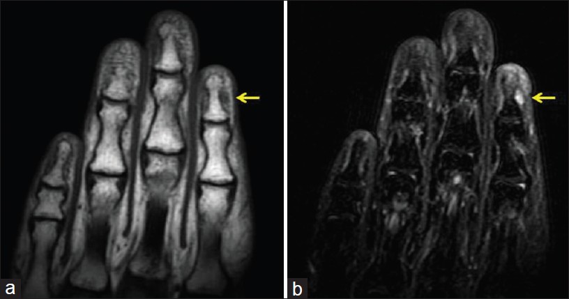 Median Canaliform Nail Dystrophy |