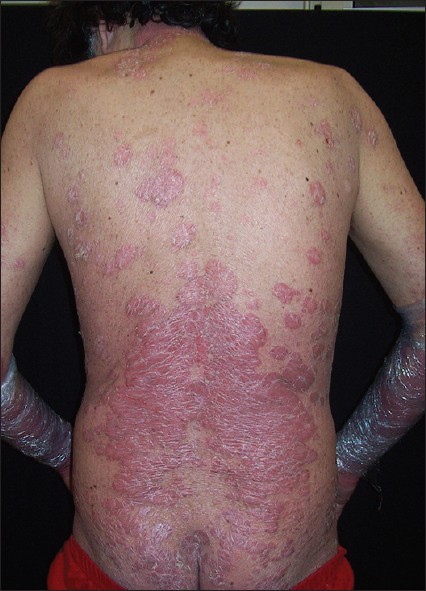 Hepatitis C Skin