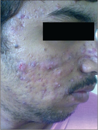 Apparently Tinea Barbae but could it be herpes ? : r/Dermatology